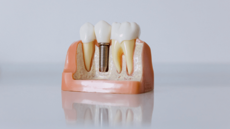 Implants dentaires à Paris