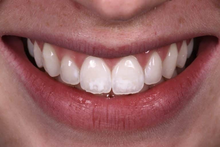 Tooth stains and dietary habits