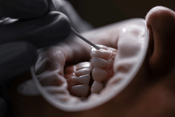 Microabrasion for fluorosis
