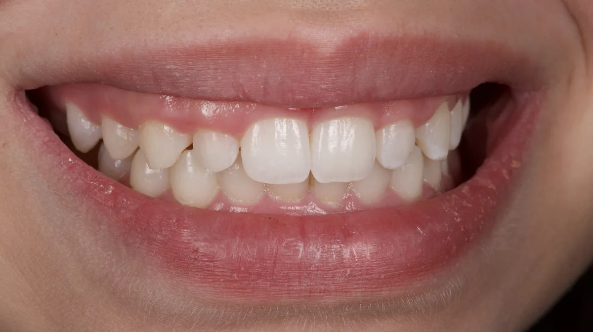 Causes du sourire gingival