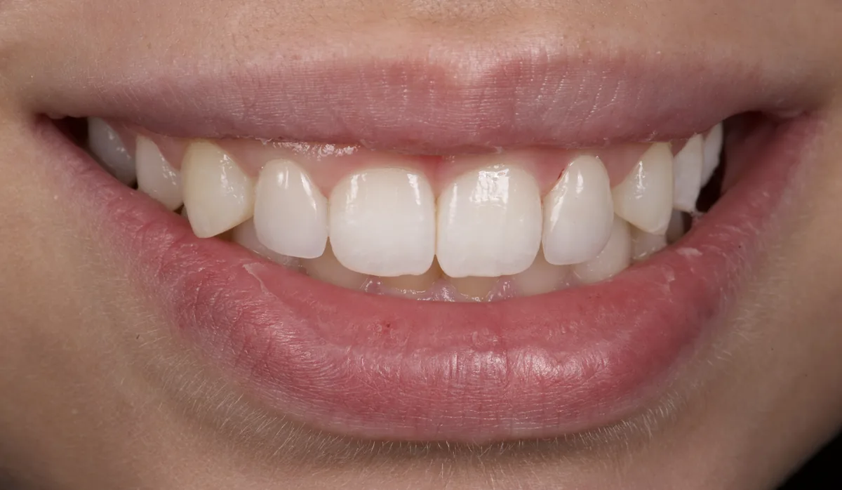 Sourire gingival