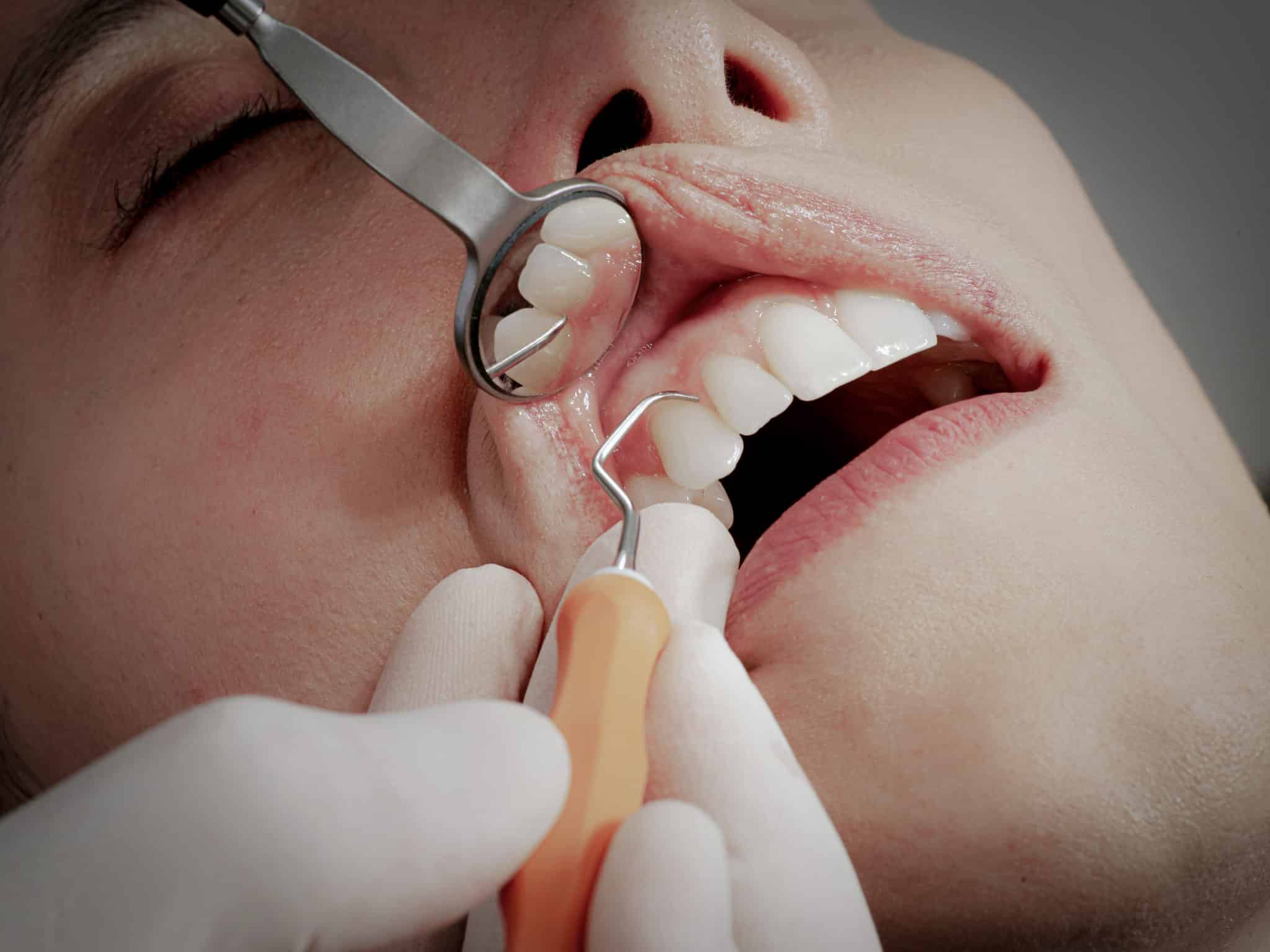 Apparence des dents plus longues