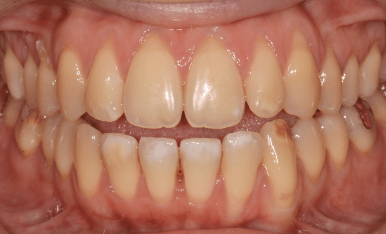 Récession gingivale avant traitement cas 3