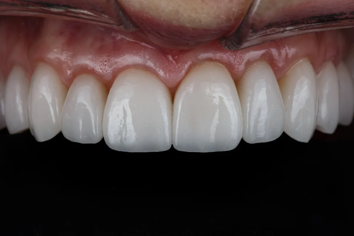 Facettes dentaires pour un sourire impeccable