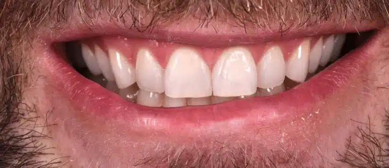 After composite dental veneers, case 1
