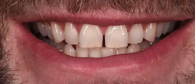Before composite dental veneers, case 1