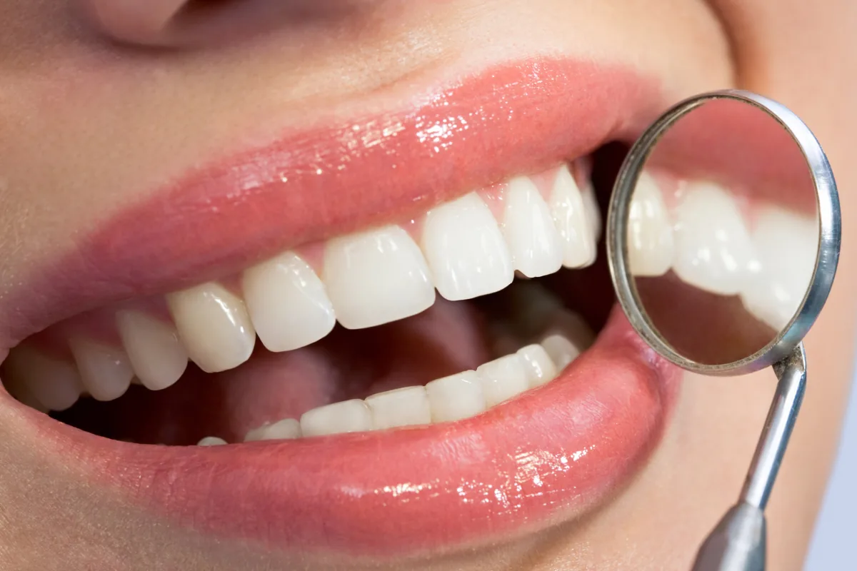 Smile with composite dental veneers