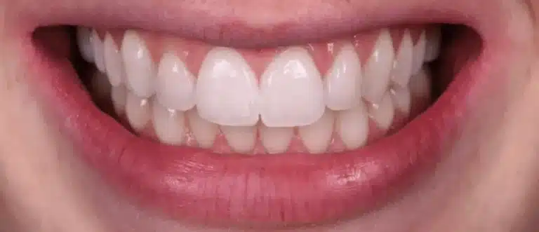 White spots on teeth after treatment, case 1