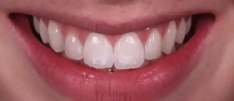 White spots on teeth before treatment, case 1