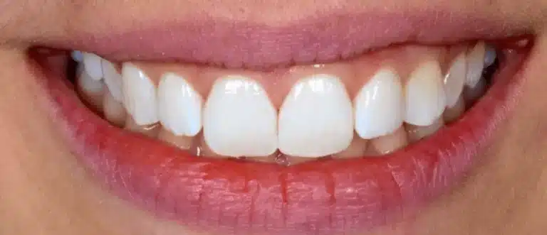 White spot removal after treatment, case 2