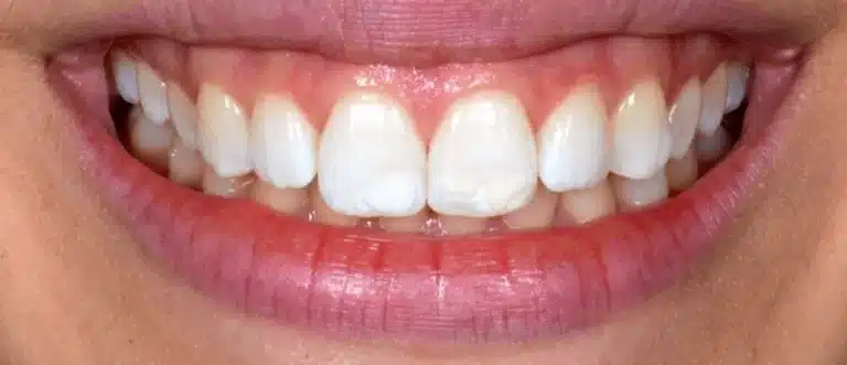 White spot removal before treatment, case 2