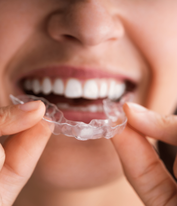 Aligneurs transparents pour traiter l’encombrement dentaire