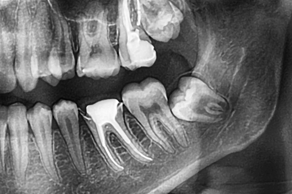 Wisdom teeth extraction