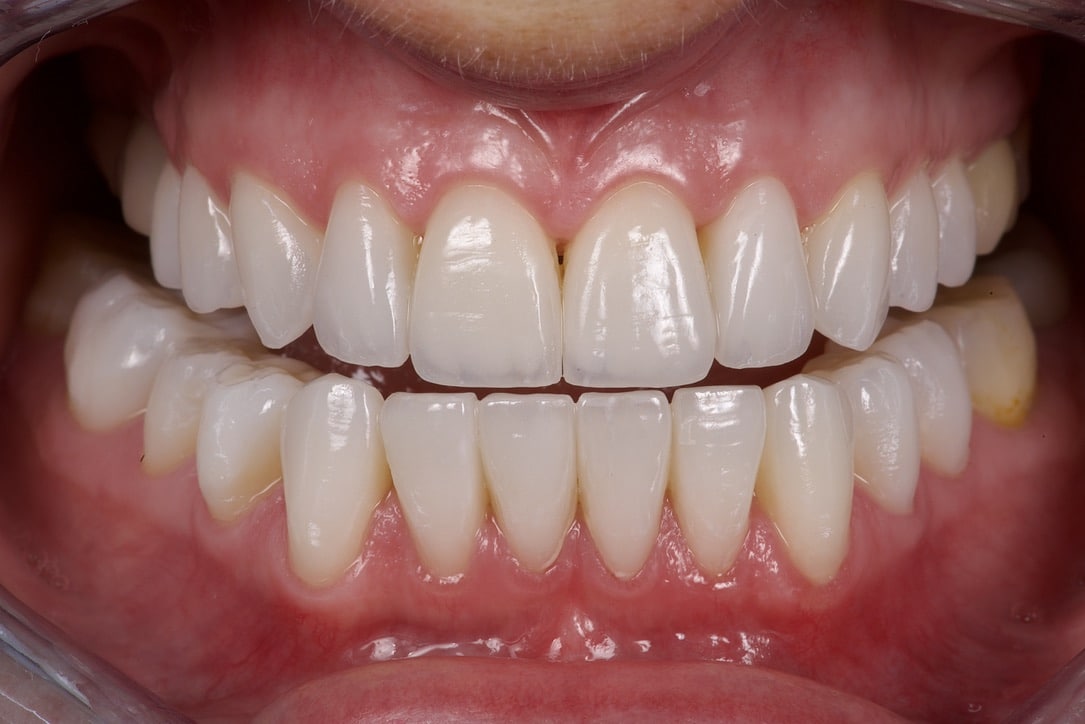 After dental veneers