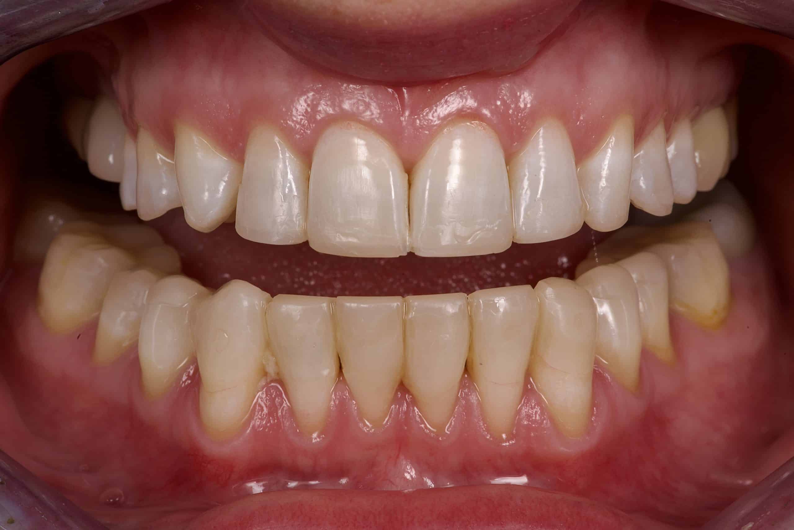 Before dental veneers