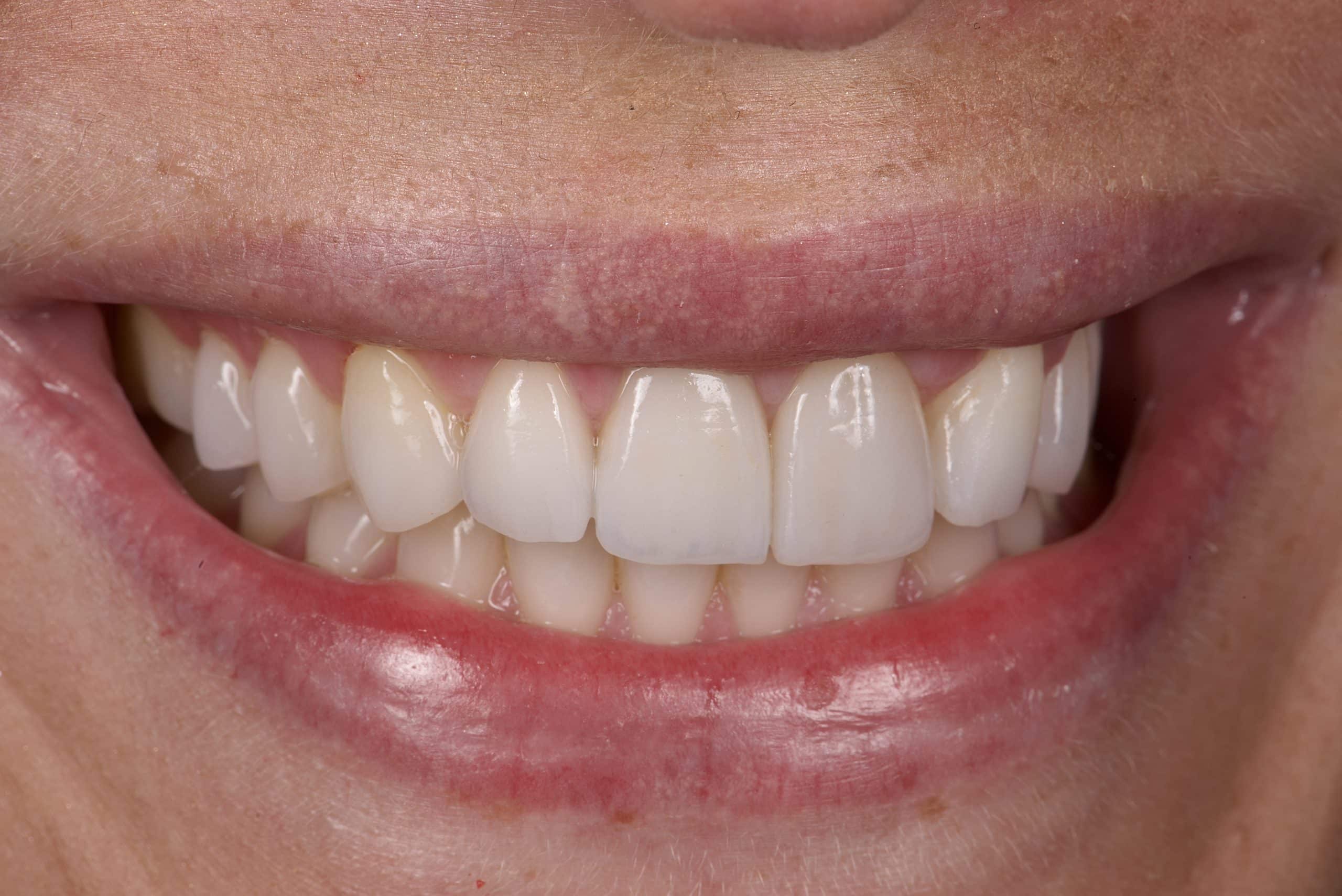 After veneers were fitted