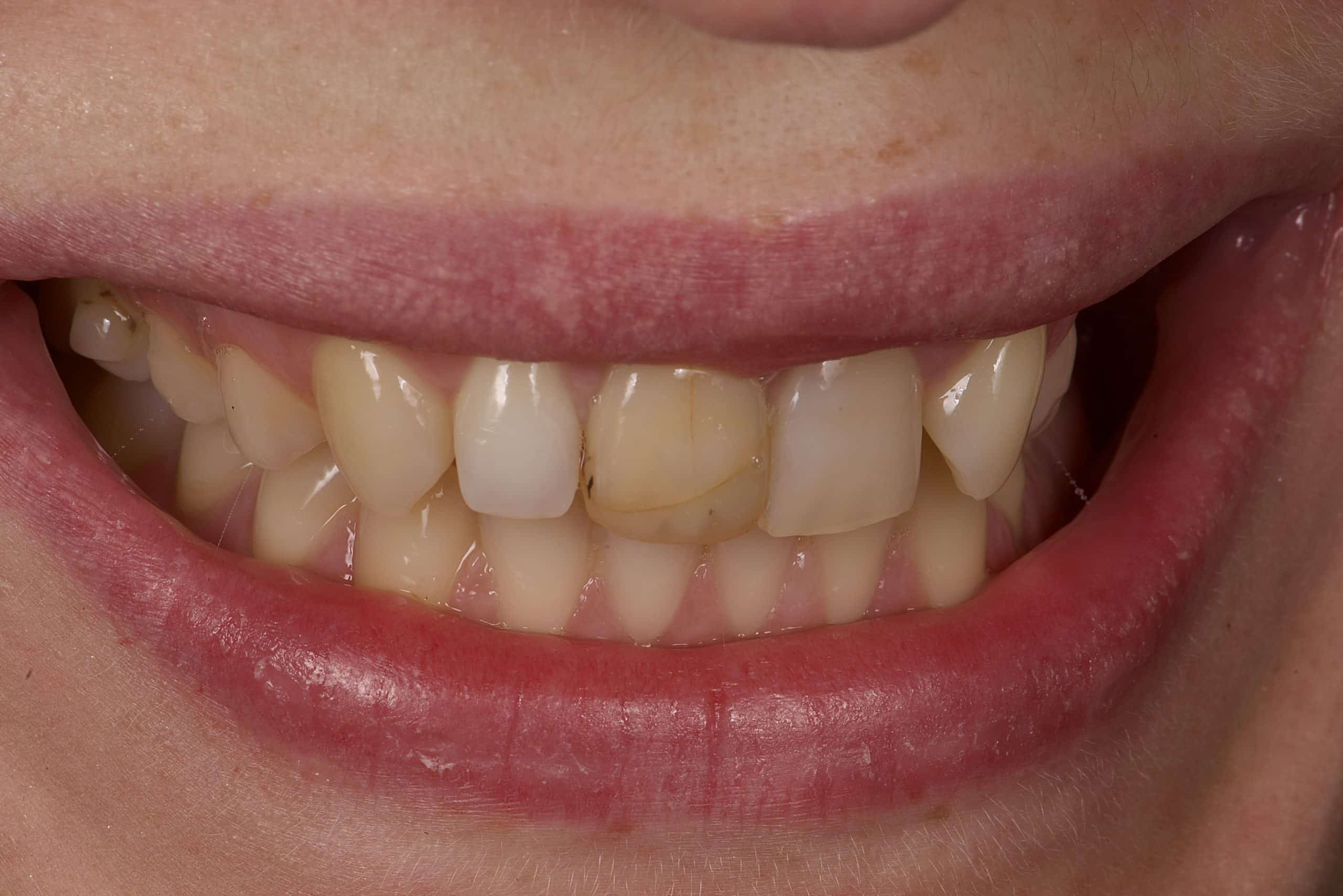 Before veneers were fitted