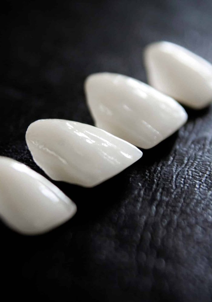 Composite dental veneers