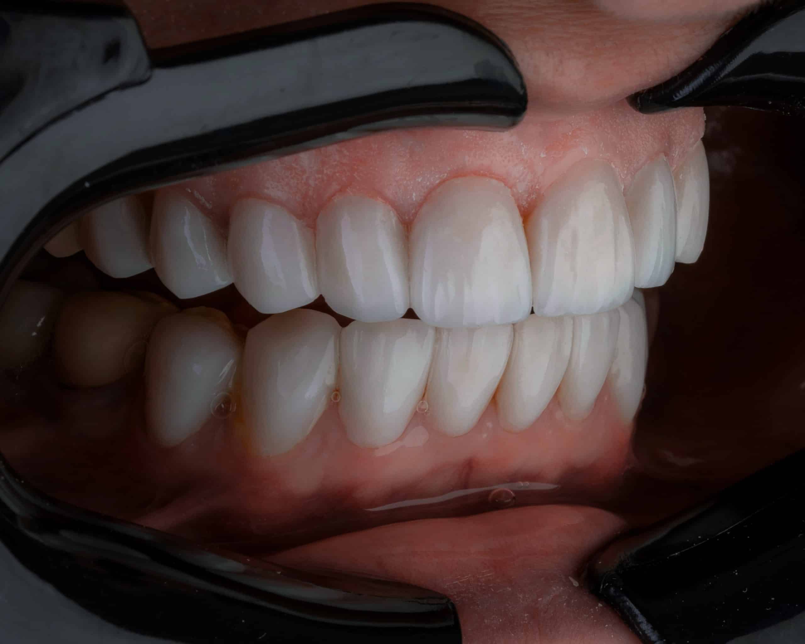 Sourire naturel après facettes dentaires
