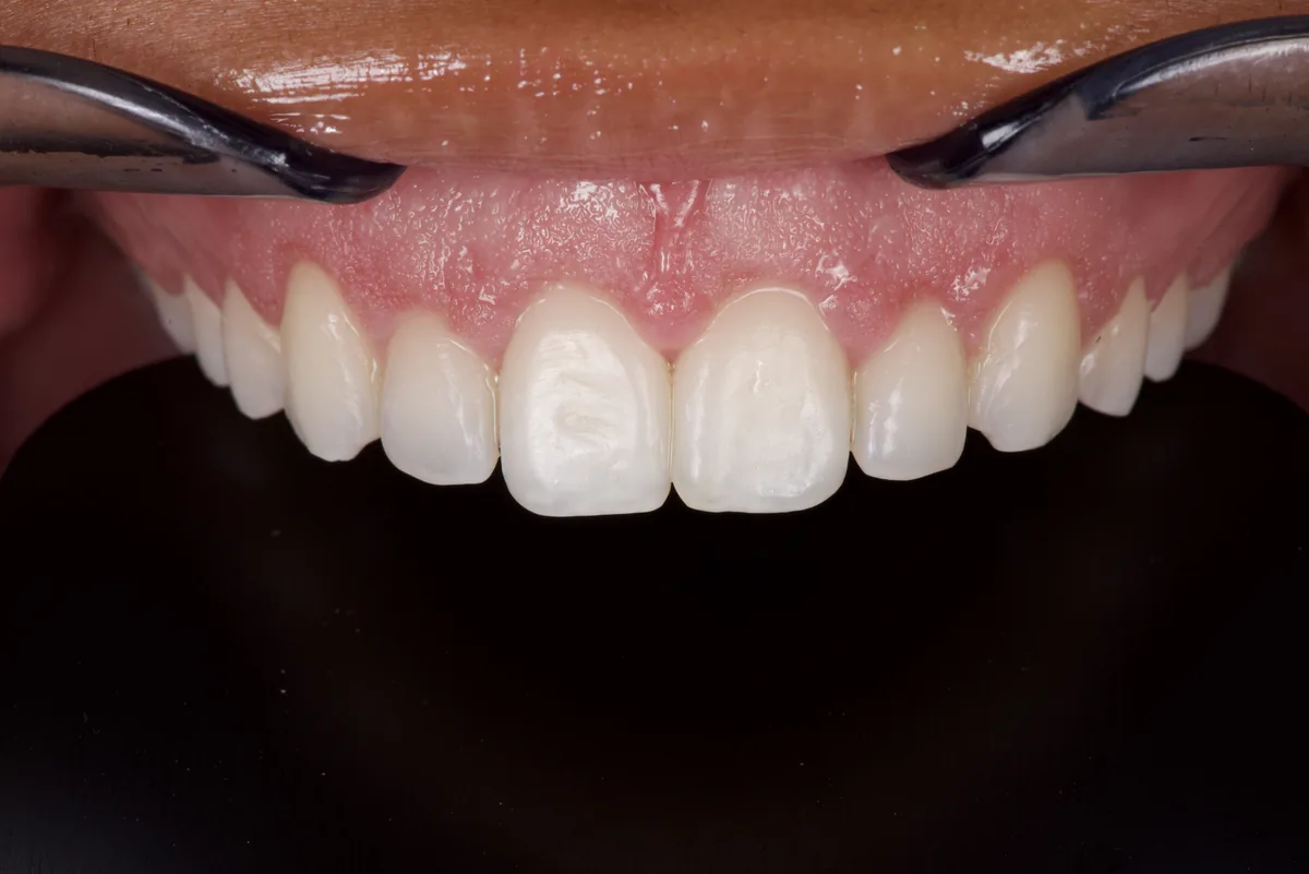 Traitement de gingivectomie à Paris