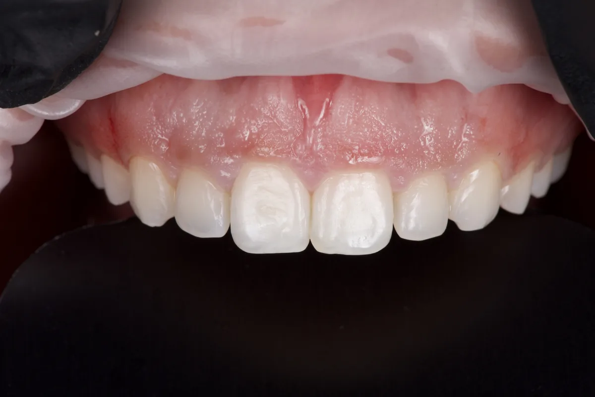 Gingivectomie au cabinet dentaire