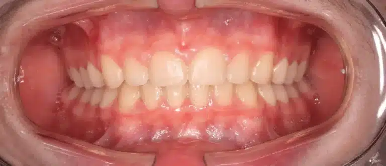 Après orthodontie Invisalign