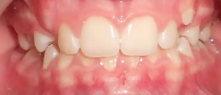 Avant alignement dentaire