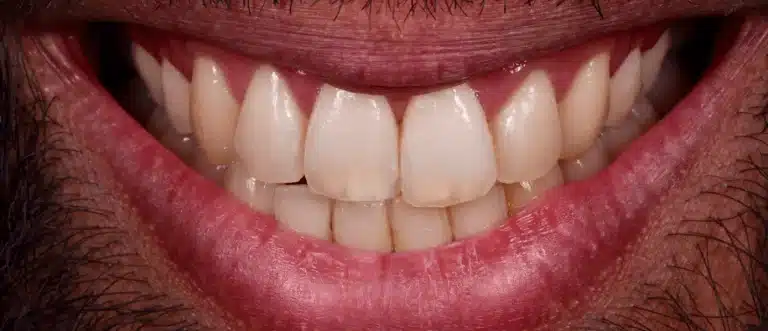 Avant correction dents tordues