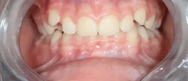 Avant orthodontie Invisalign