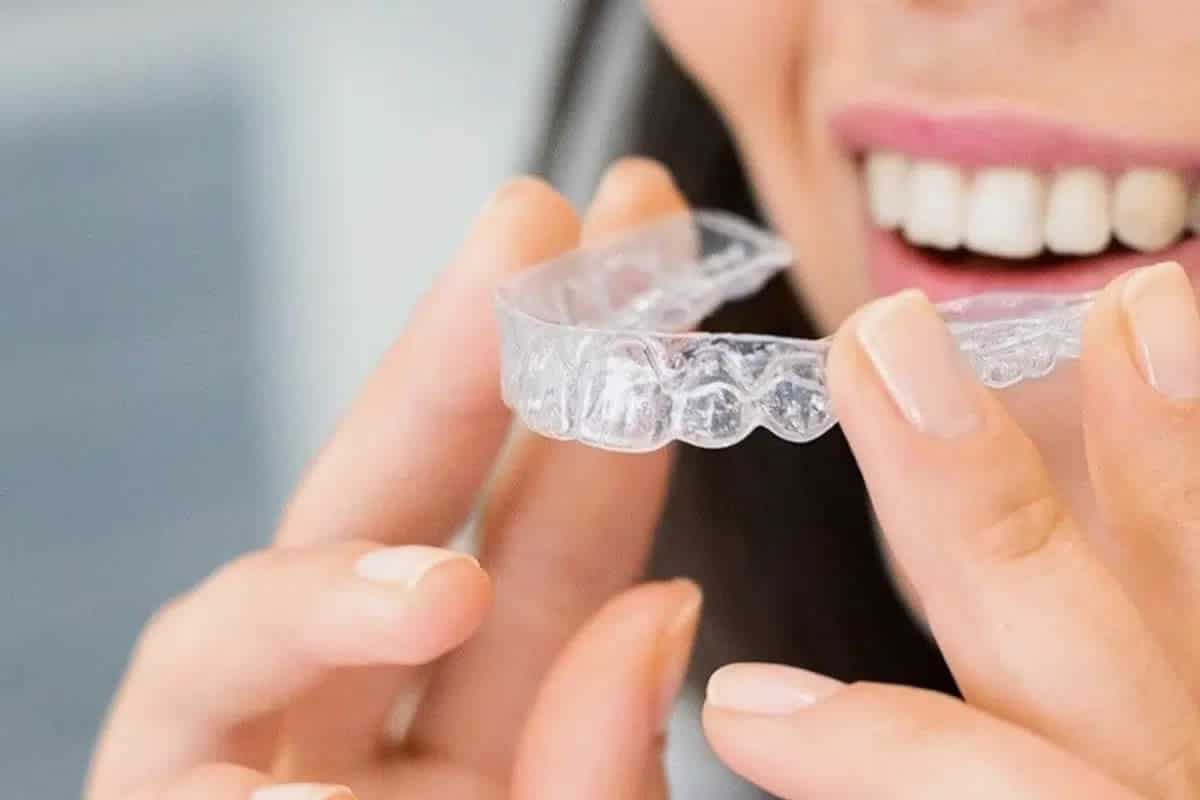 Solutions orthodontiques discrètes pour adultes