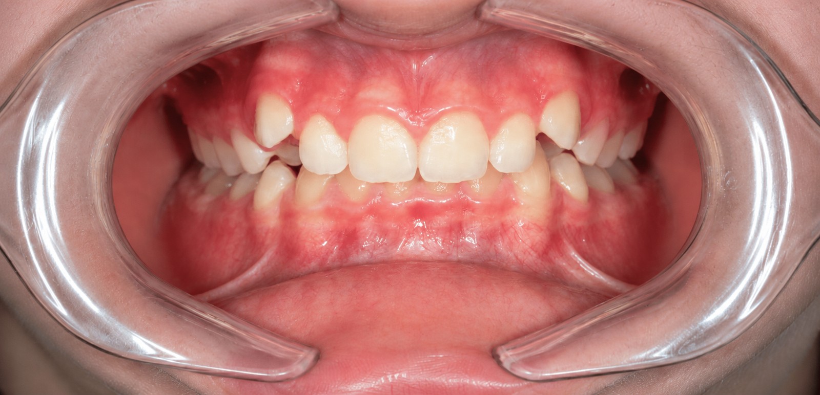 Orthodontie avant