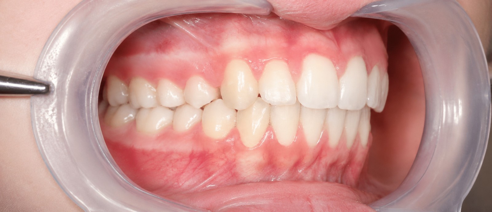 Après traitement orthodontique, cas 2