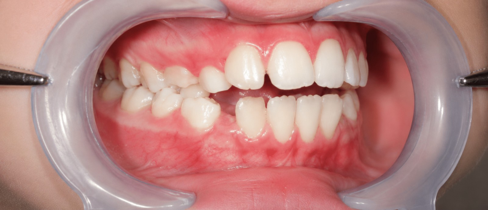 Avant traitement orthodontique, cas 2