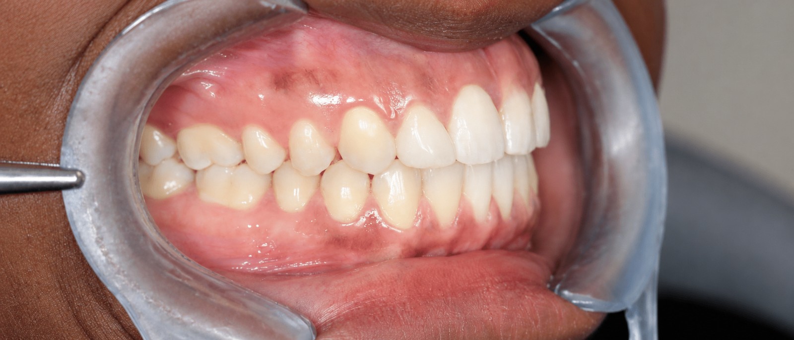 Après traitement orthodontique, cas 3