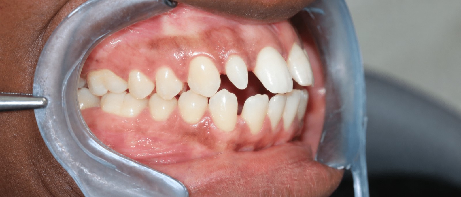 Avant traitement orthodontique, cas 3