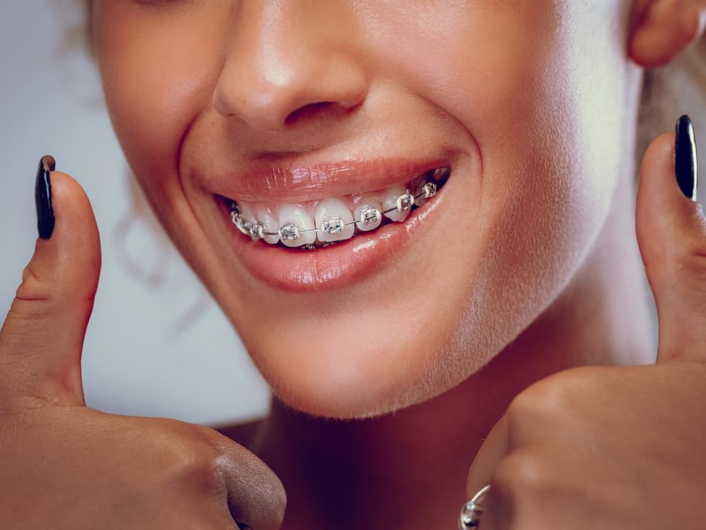 Patiente souriante avec un appareil orthodontique fixe