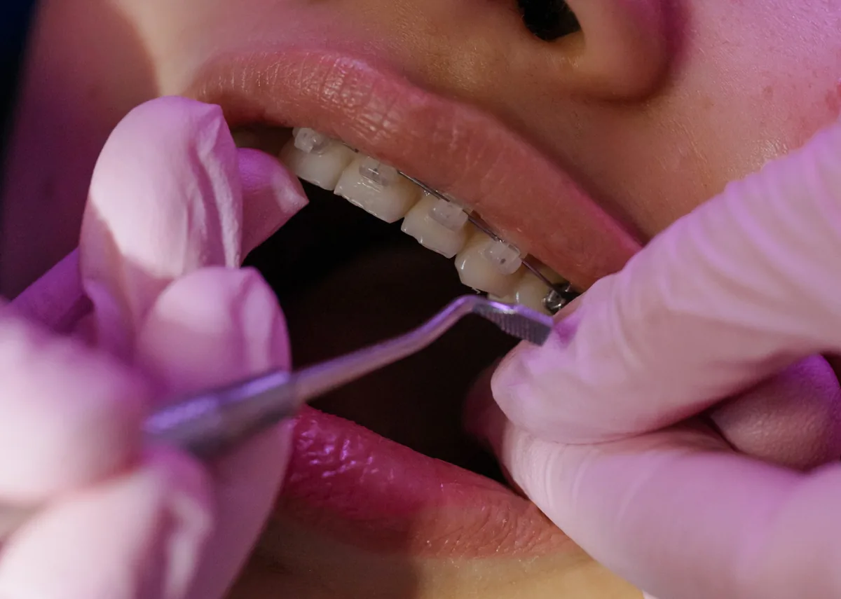Traitement orthodontique fixe avec bagues dentaires
