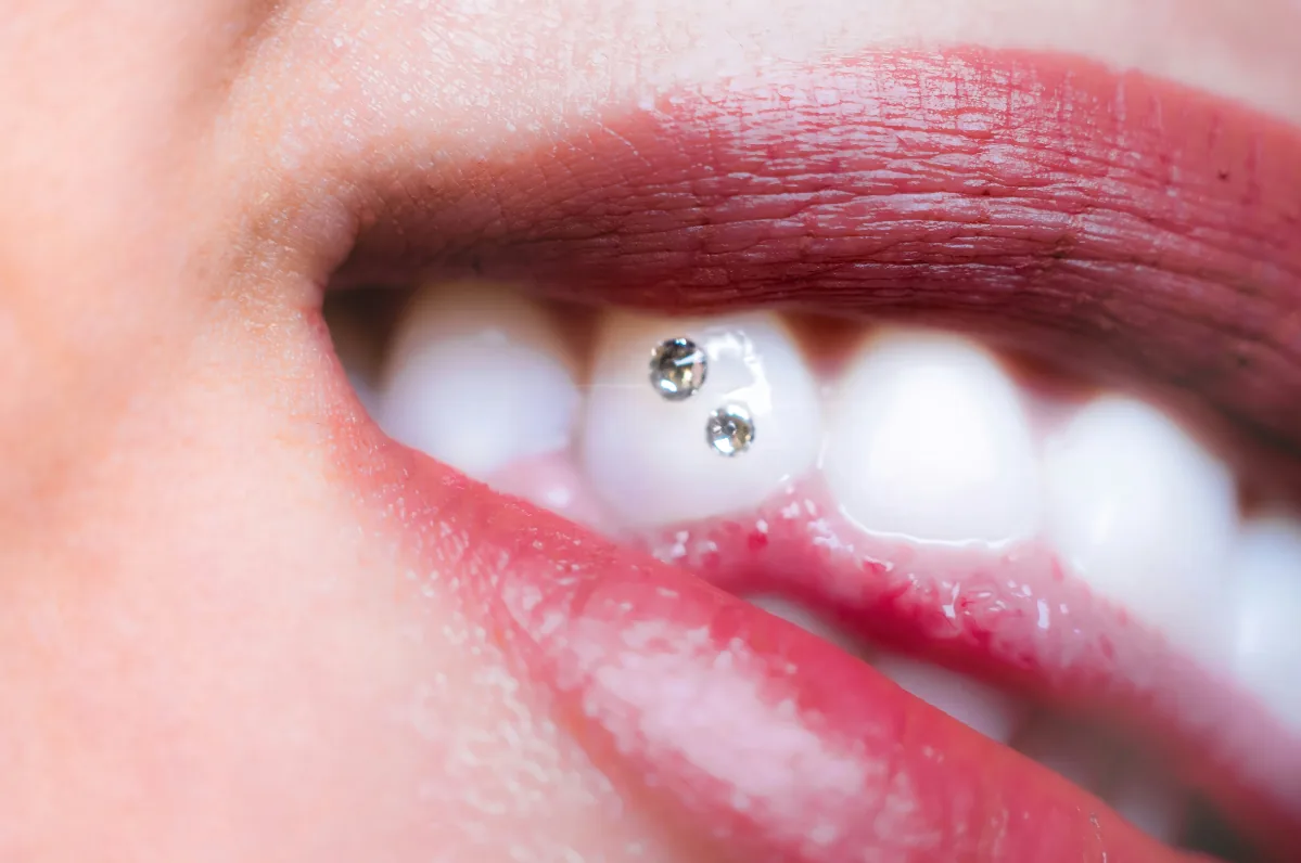 Smile with a tooth gem