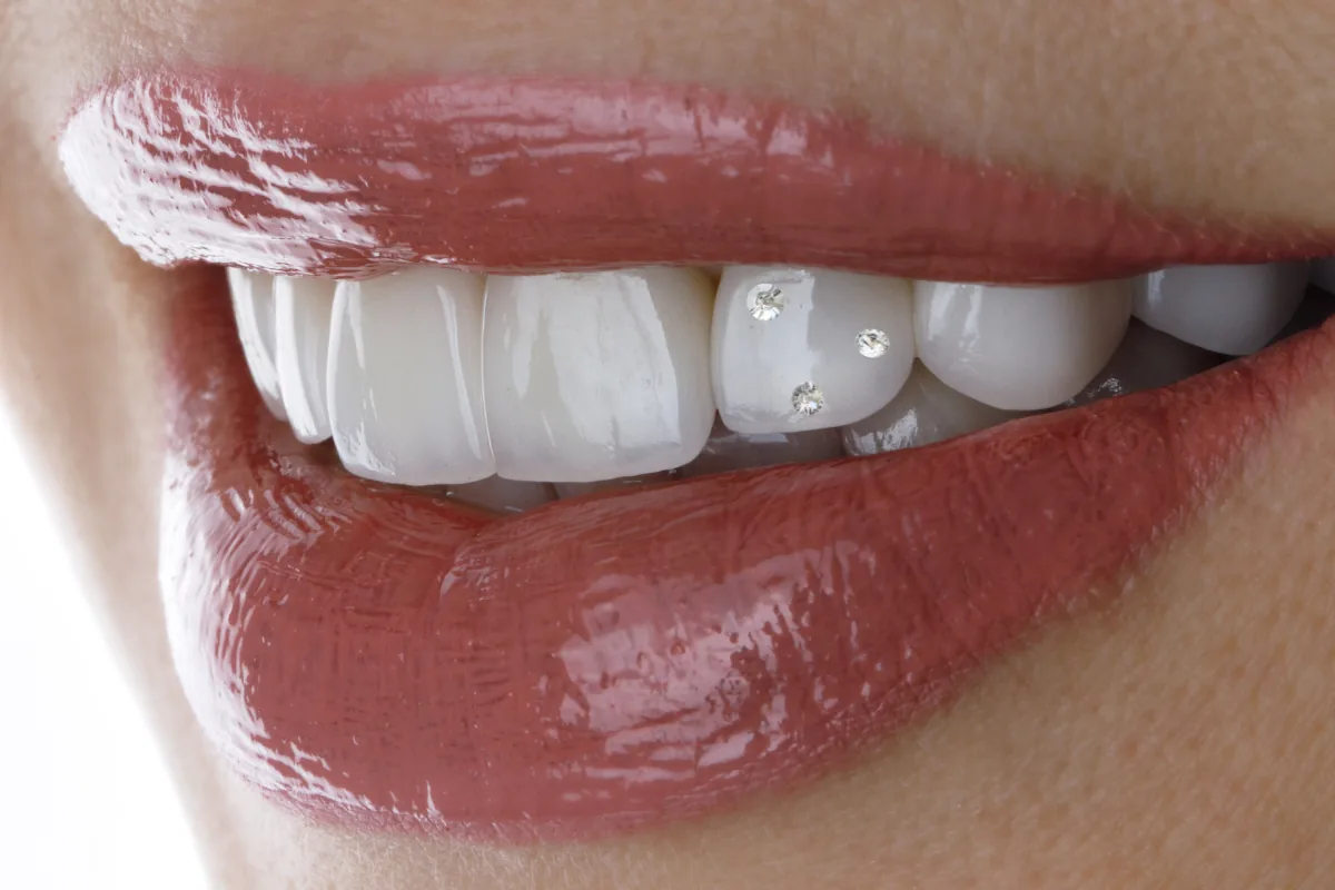Risks associated with tooth gems