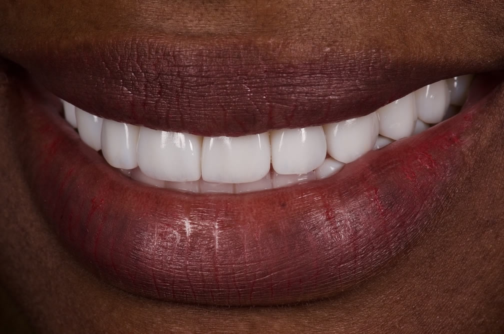 Sourire après réhabilitation complète, cas 1