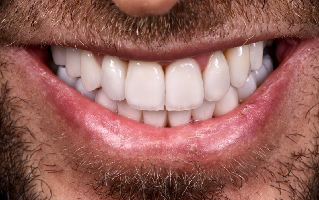 Dentition après traitement complet, cas 3