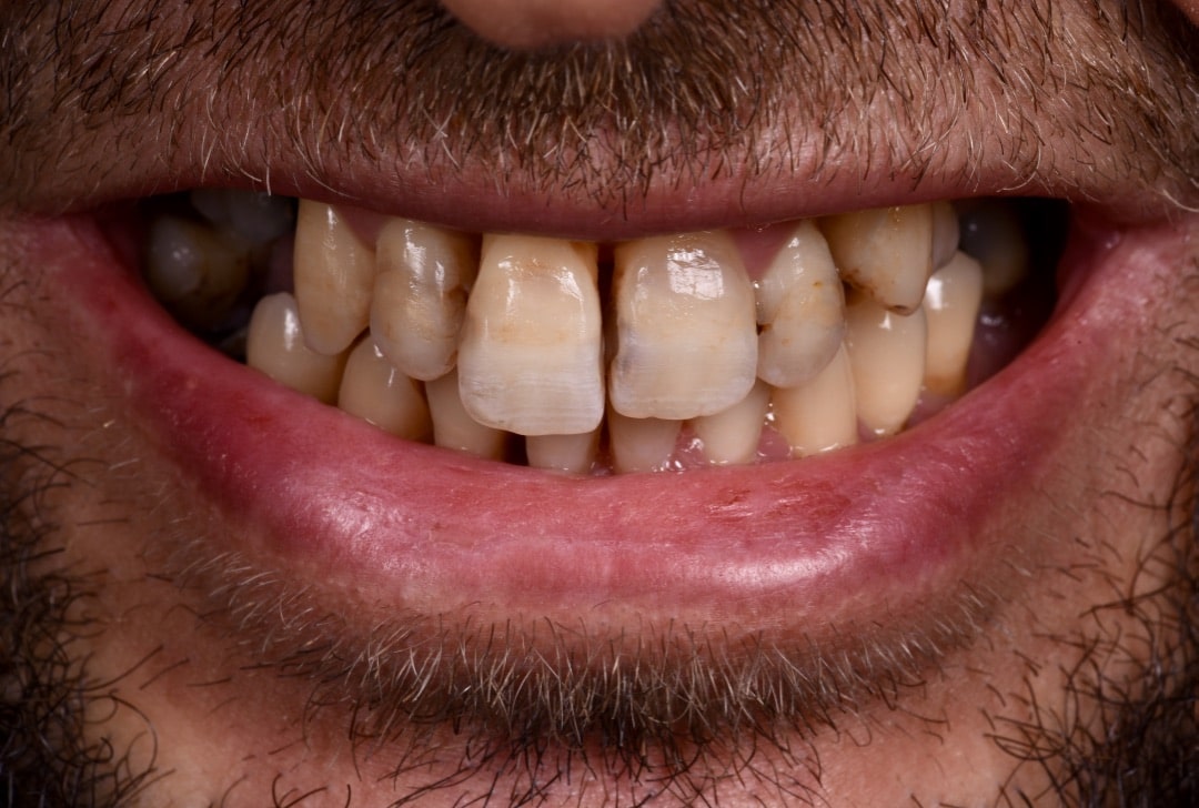 Dentition avant traitement complet, cas 3