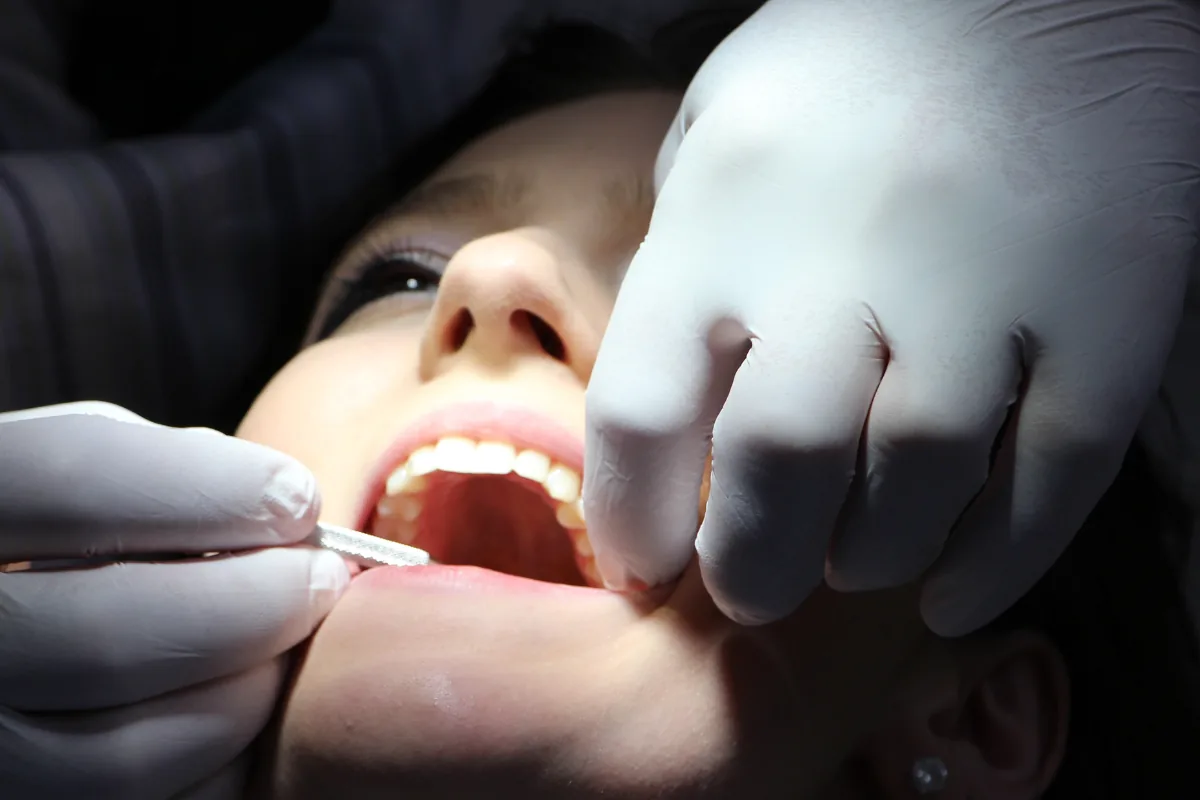 Gingivectomie