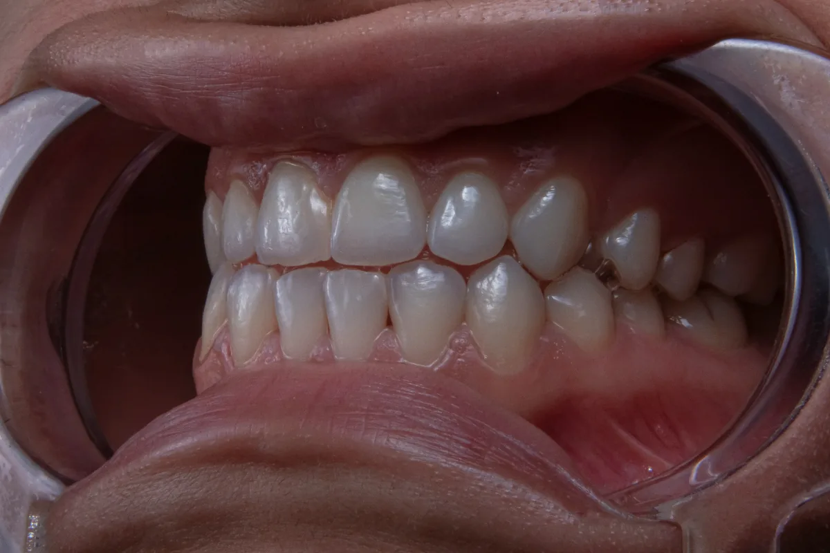 Sourire gingival