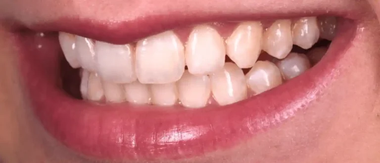 Traitement de la fluorose dentaire après — cas 2