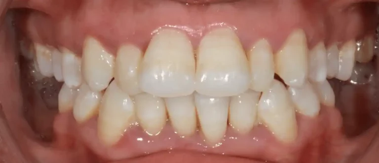 Traitement de la fluorose dentaire après — cas 3
